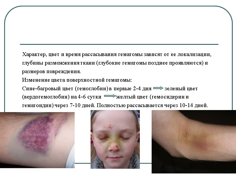 Характер, цвет и время рассасывания гематомы зависят от ее локализации,  глубины разможжения ткани